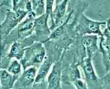 Adrenocortical Carcinoma Cells (ACC)