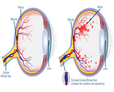 Central Retinal Vein Occlusion (CRVO)