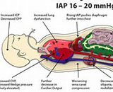 Abdominal Compartment Syndrome (ACS)