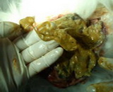 Abdominal Infection (AI)