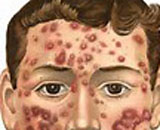 Acne Vulgaris (AV)