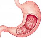 Acute Gastritis (AG)