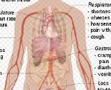 Anaphylactic Shock (AS)