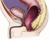 Imperforate Anus (IA)