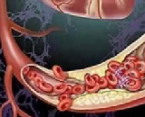 Aortic Thrombus (AT)