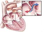 Atrial Sseptal Defect (ASD)