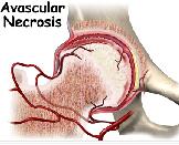 Avascular Necrosis (AN)