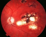 Chorioretinitis (CR)