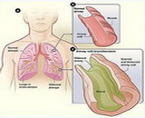 Bronchiectasis (BC)