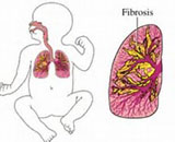 Bronchopulmonary Dysplasia (BPD)