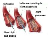 Carotid Artery Restenosis (CAR)