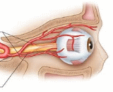 Central Retinal Artery Occlusion (CRAO)