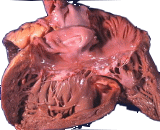 Chronic Pulmonary Hypoxic Ischemic Heart Disease (CHHD)