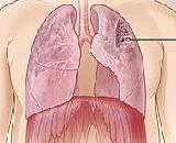 Chronic Obstructive Pulmonary Disease (COPD)