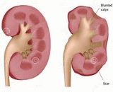 Chronic Pyelonephritis (CP)