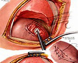 Congenital Diaphragmatic Hernia (CDH)