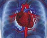 Congestive Heart Failure (CHF)