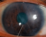 Corneal Endothelial Injury (CEI)