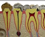 Dental Fluorosis (DF)