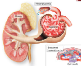 Diabetes Mellitus (DM)