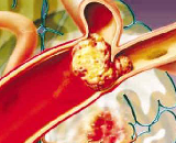 Disseminated Intravascular Coagulation (DIC)