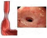 Esophageal Stenosis (ES)