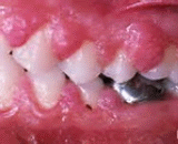 Gingival Hyperplasia (GH)