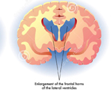 Huntington's Disease (HD)