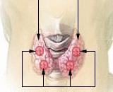 Hyperparathyroidism (HP)