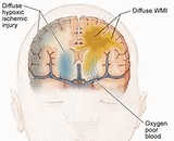 Hypoxic Ischemic Encephalopathy (HIE)