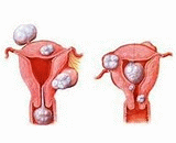 Hysteromyoma (HM)