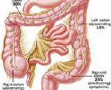 Colitis