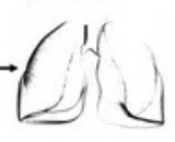 Ischemia Reperfusion Lung Injury (IRLI)