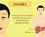 Jaundice