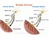 Multiple Sclerosis (MS)