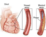 Myocardial Ischemia (MI)