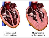 Myocardiosis