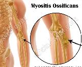 Myositis