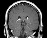 Neurosarcoidosis (NS)