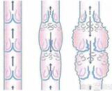 Occlusive Angitis (OA)