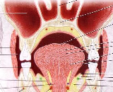 Oral Ulcer (OU)