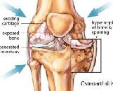 Osteoarthritis (OA)