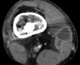 Osteomyelitis (OM)