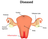 Pelvic Inflammatory Disease (PID)