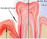 Periodontitis (PD)