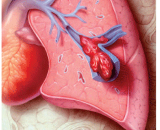 Pulmonary Embolism (PE)