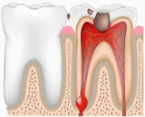 Pulpitis