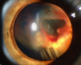 Rhegmatogenous Retinal Detachment (RRD)