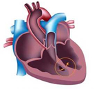 Rheumatic Heart Disease (RHD)