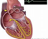 Sick Sinus Syndrome (SSS)